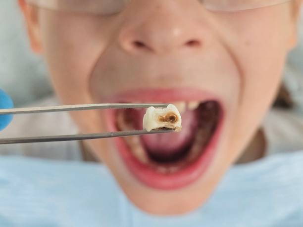 Best Broken or Chipped Tooth Repair in Emerson, NJ
